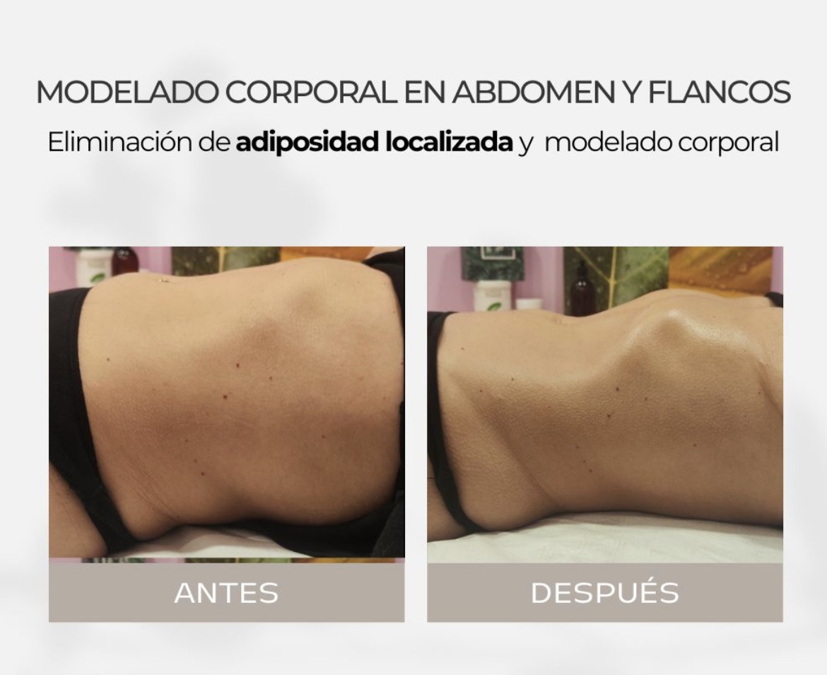 Antes y después - Modelado Corporal Abdomen